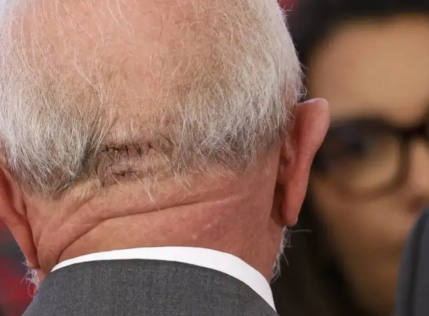 cirurgia de Lula
